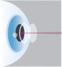 Eye Graphic with Laser