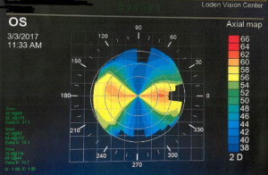 eye topography 2