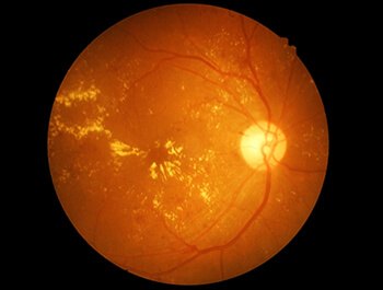 Macular Degeneration